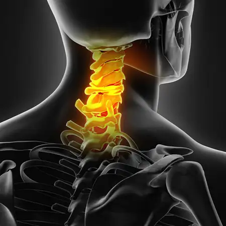 Herniated cervical discs