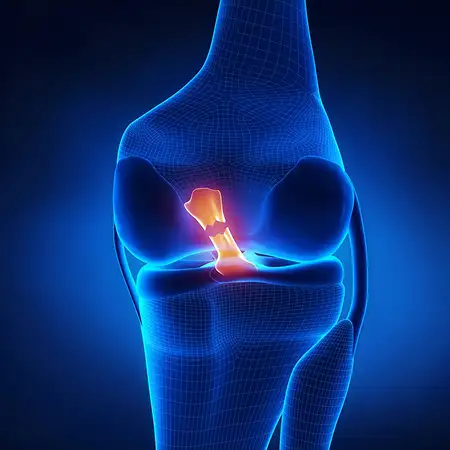 Ligament sprains and meniscus tears